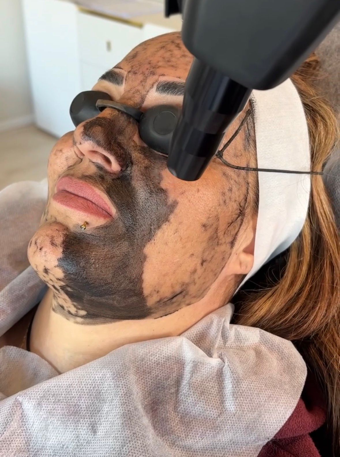 Tijdens — Carbon laser peel in uitvoering